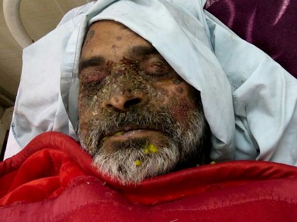 Help Mr Anil Kapil, who is in ICU, fight Sepsis and Bullous Pemphigoid