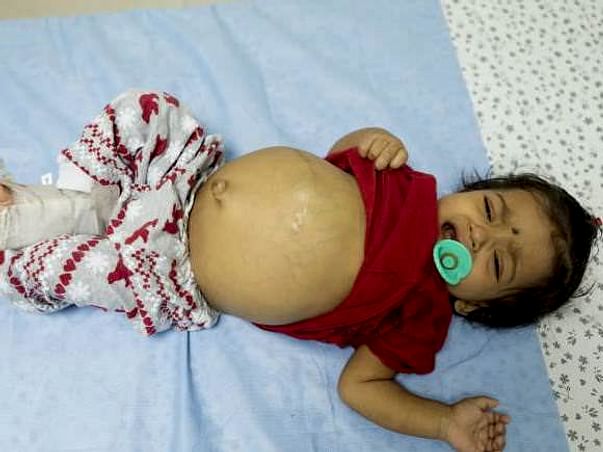 At the age of 9-months baby Pranavi has a serious liver disease