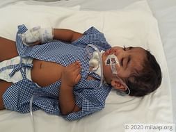 This Baby's Brain Presses On His Spinal Cord And He Chokes On His Food
