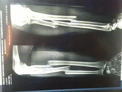 Before Operation X-Ray