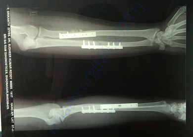 After Operation X-Ray