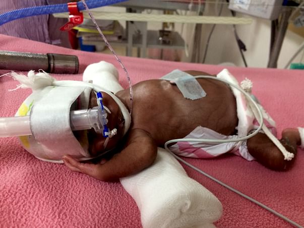 Help for my pre-mature baby
Born in 25th week