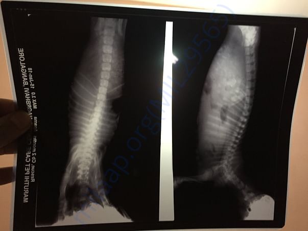 X-Ray showing the condition