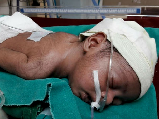 3-Month-Old Baby Needs An Urgent operation
