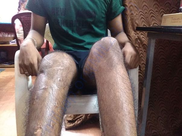 Picture of shorten leg