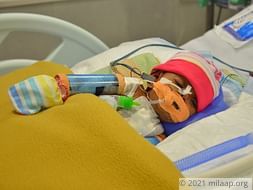 Help This Baby Girl Who Was Born Premature With 3 Holes In Her Heart