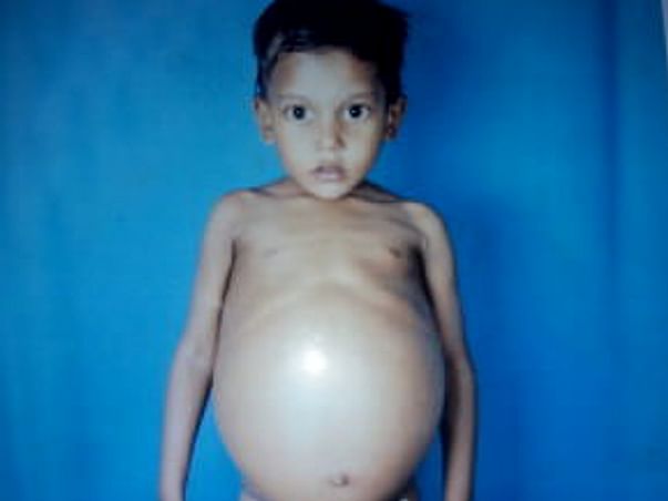 Help Joseph Raj From Gaucher Disease