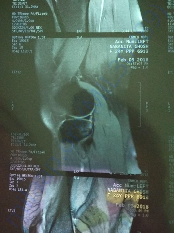 MRI SCAN