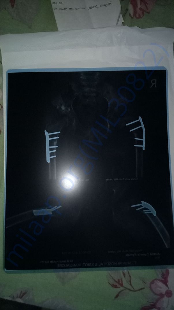 After surgery xray