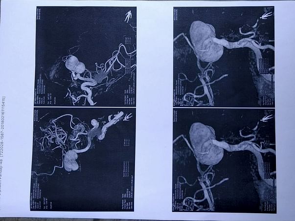 Need help for Brain hemorrhage patient