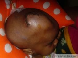 Baby Arohi is suffering from a severe brain condition and needs help