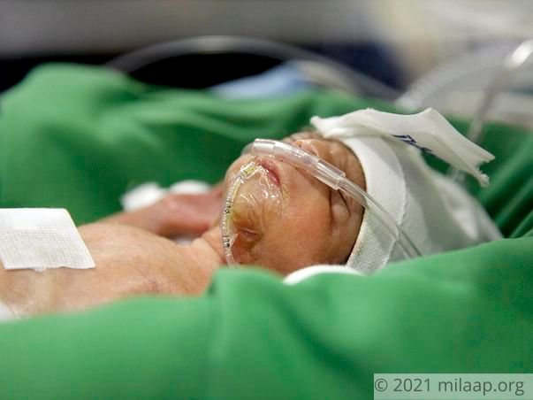 Only 6 Days Old, This Baby Is Not Strong Enough To Breathe On His Own