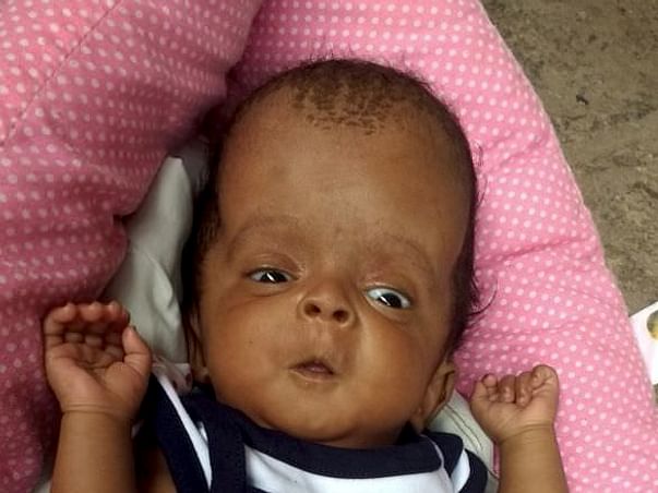 Help Baby Deepidi having blockage in one nerve in head