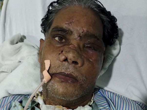Please Help My father Undergo Eye And Throat Surgery