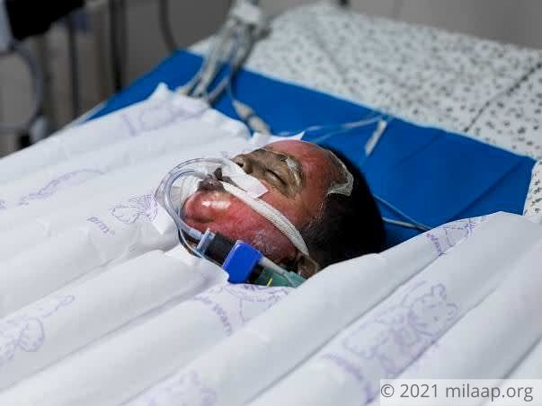 50% Of This Baby’s Body Is Burnt And He’s Struggling To Live