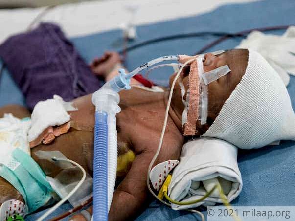" 2-weeks-old Baby Is Fighting To Stay Alive After A Heart Surgery"