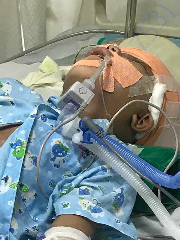 Sumit under ventilator and responding to treatment . Let’s pray