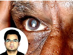 Sponsor A Cataract Surgery