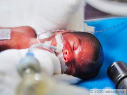 Help Akshaya and Mayur save their prematurely born twins