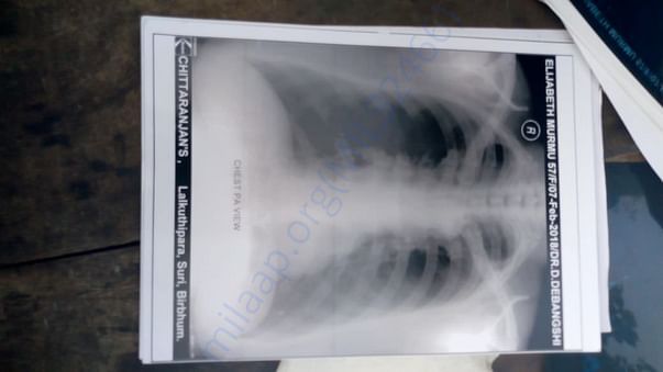 Chest X-RAY