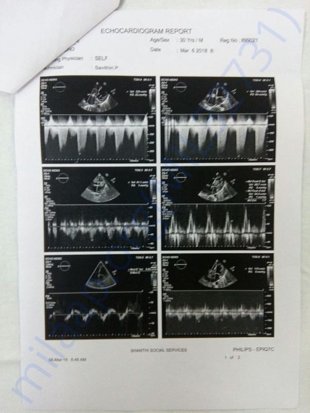 Kidney transplantation