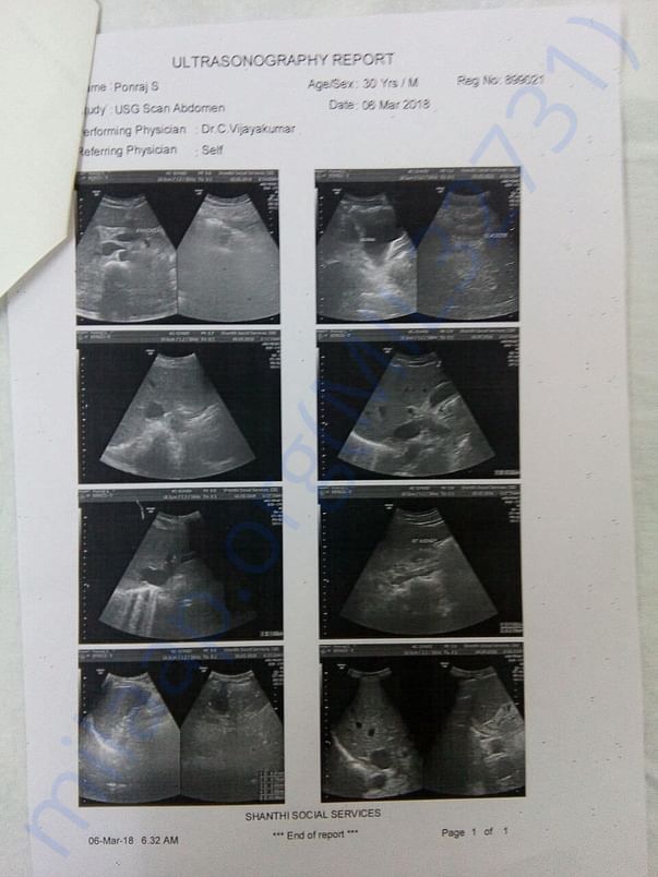 Kidney transplantation