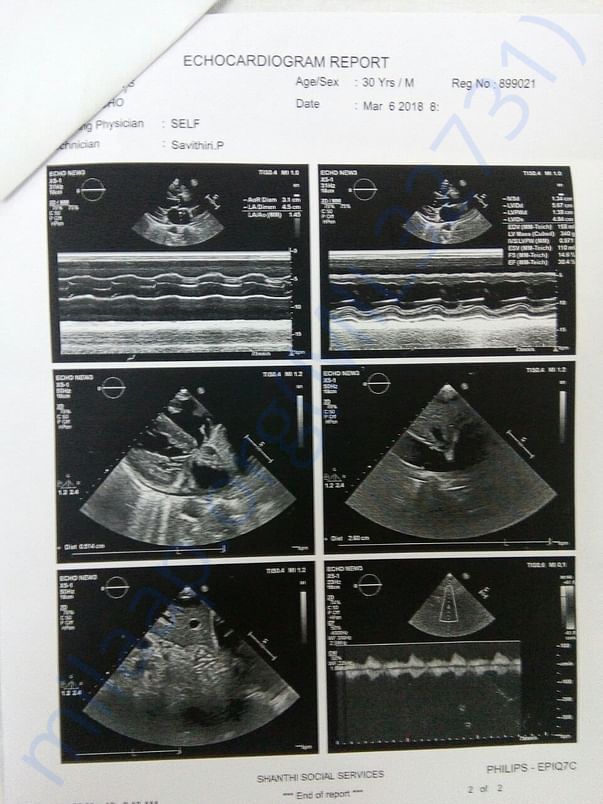 Kidney transplantation