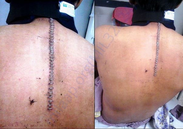 Laminectomy done from C7 to T6