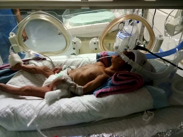 Help Kumara Swamy To Save His Premature Born Baby Boy
