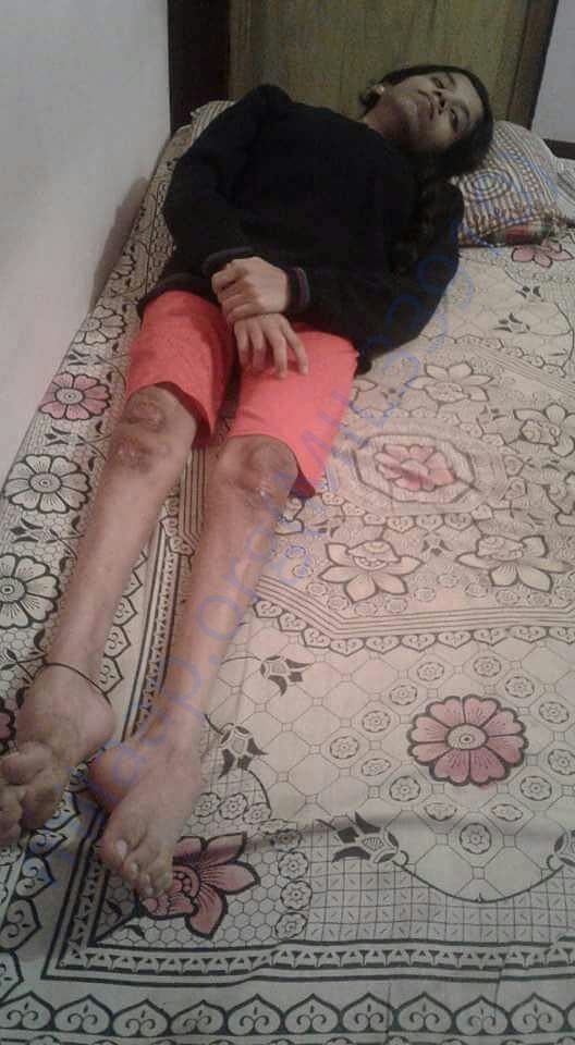 From 5 years she attached to bed in same position..help her