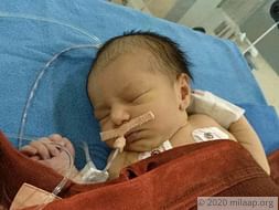 4 Days Old, This Baby Girl Risks Losing Her Life To A Heart Disease
