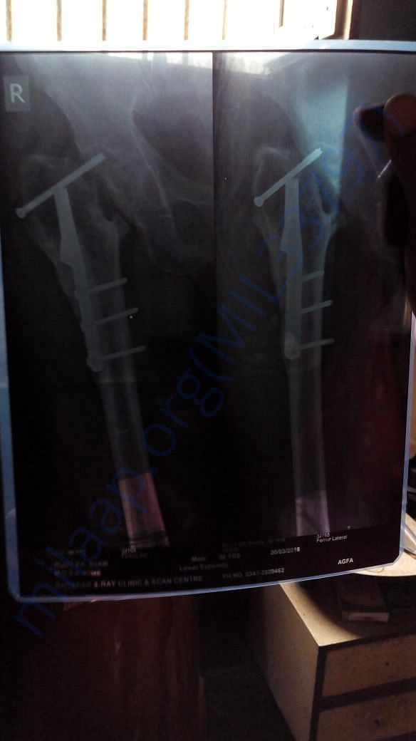X-ray of right leg(hip portion)