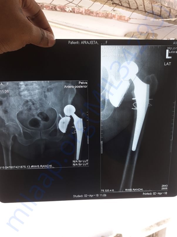 X ray 1