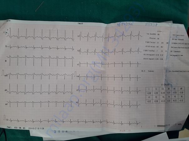 Ecg