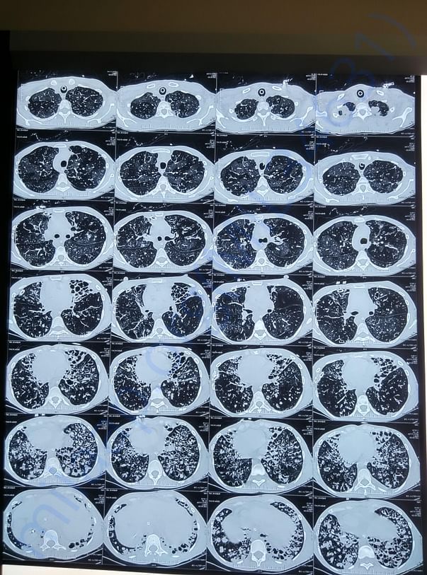 CT scan of lungs