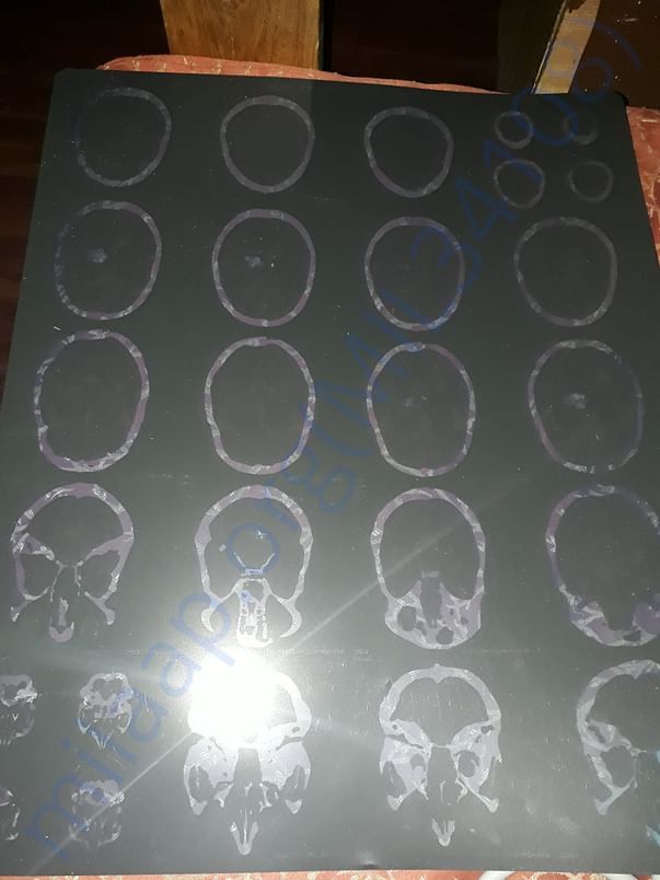 Brain CT