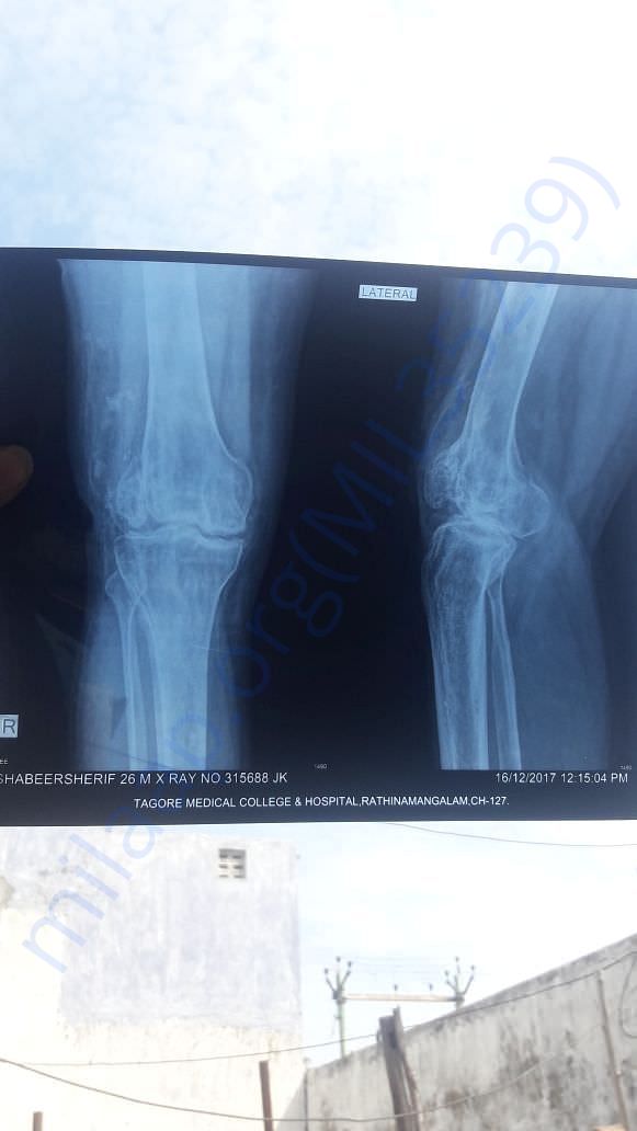 xray of the complication