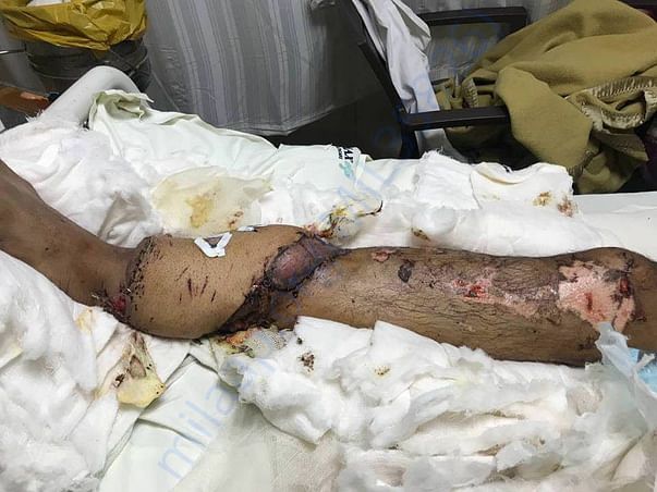 old image of leg before operation