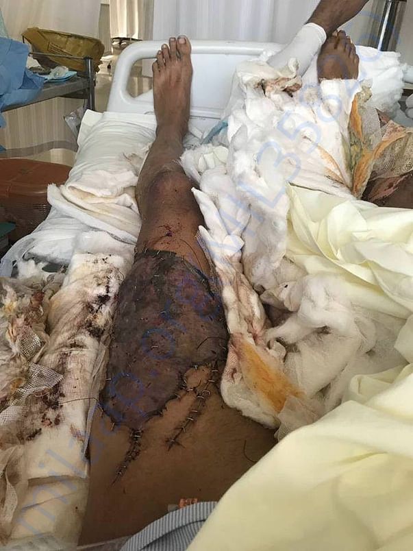 leg condition before operated