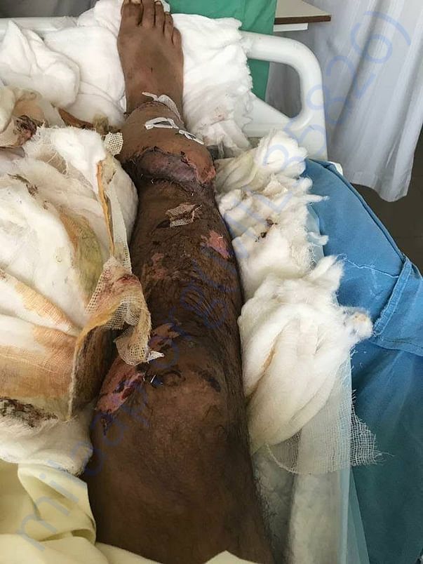 leg image before operated