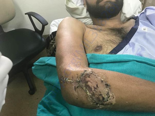 Hand image after operated but still treatment in progress