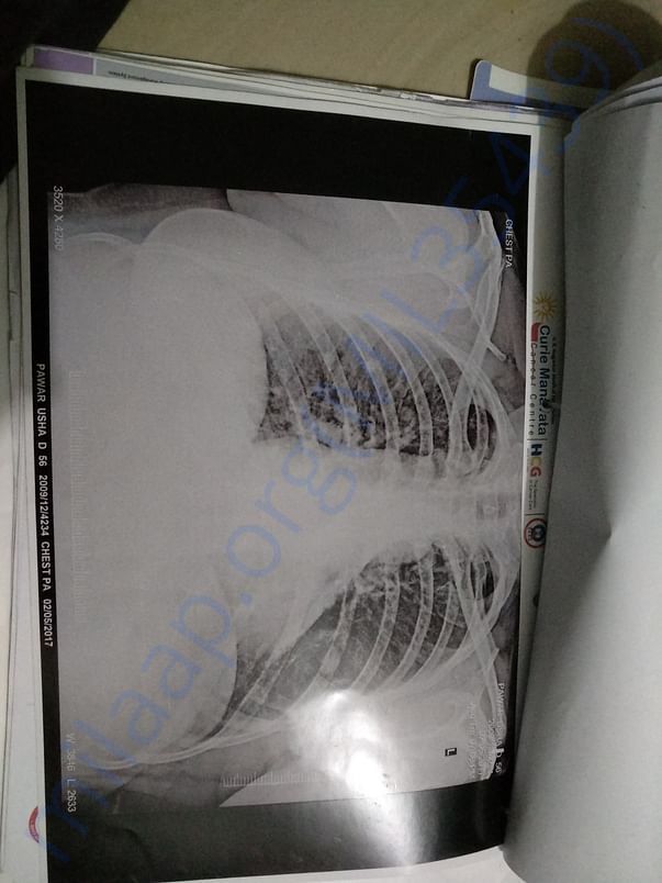 02.05.2017 Lungs xray