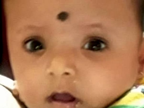 Help Prapti fight from Bicoronal Synostosis