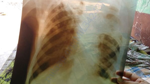 X-ray shows how he effected with Tuberculosis