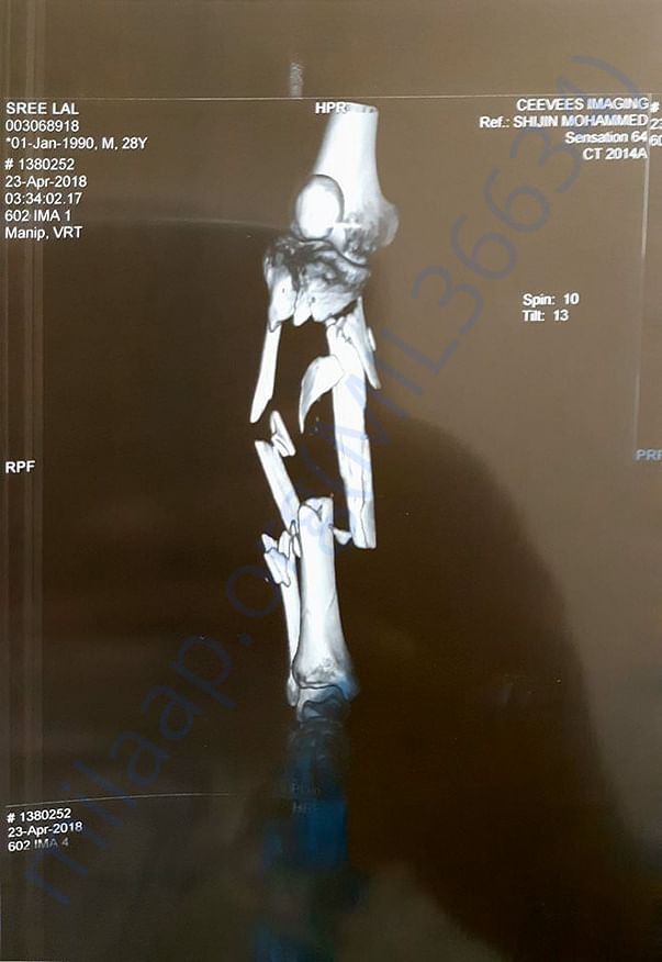 xray(leg)
