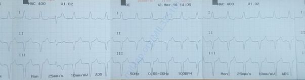 ECG - 02