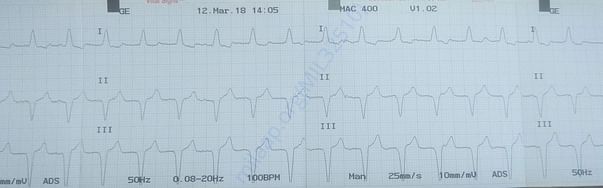 ECG - 03