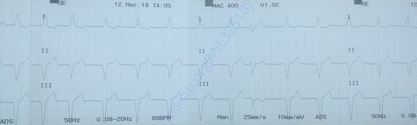 ECG - 04