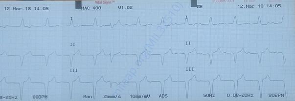 ECG - 05