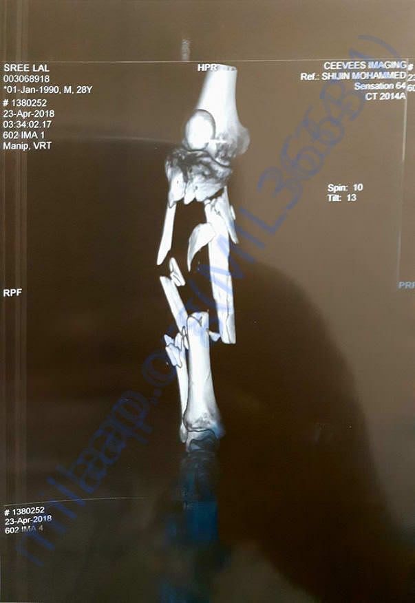 Xray
